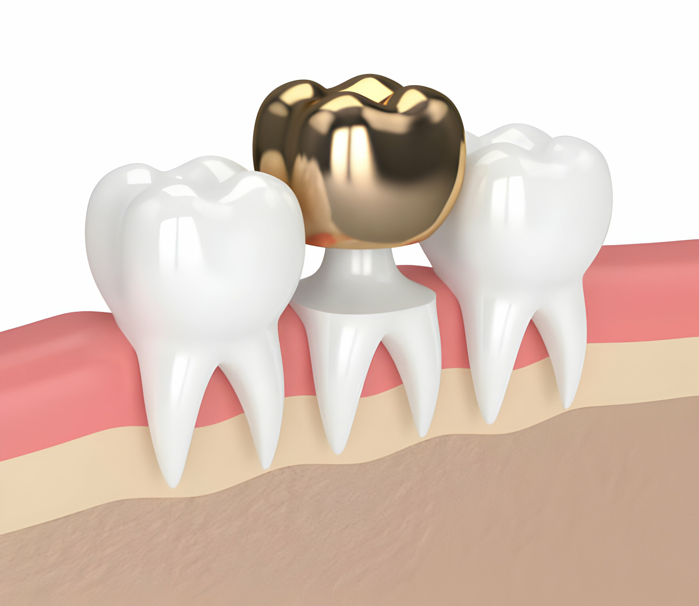 Everything You Need to Know About Porcelain Crowns_3