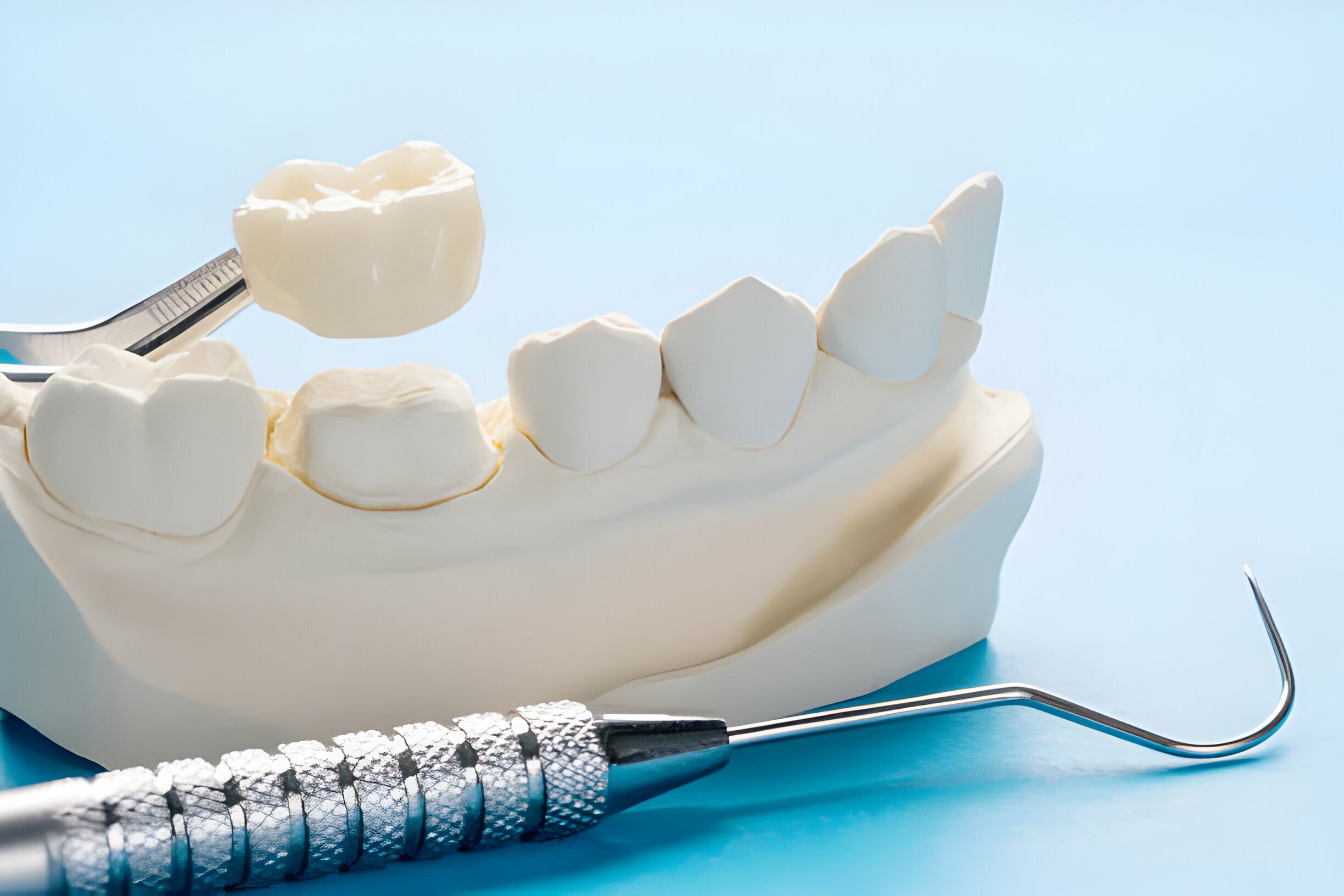 Everything You Need to Know About Porcelain Crowns_2