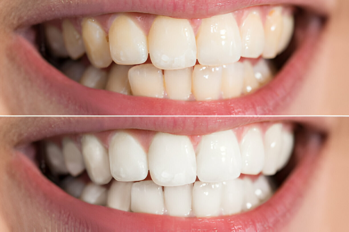 Professional Teeth Whitening vs. At-Home Kits: Which is Better?_2