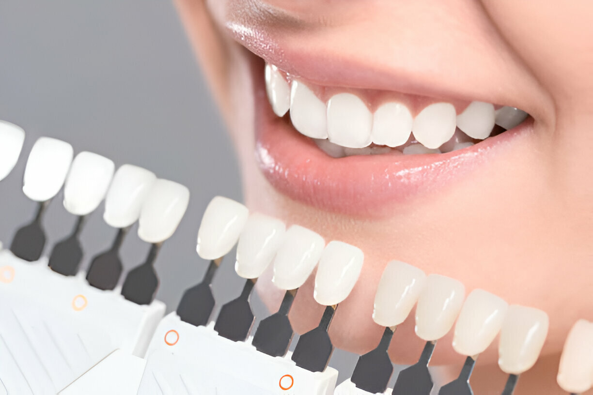 Professional Teeth Whitening vs. At-Home Kits: Which is Better?_3