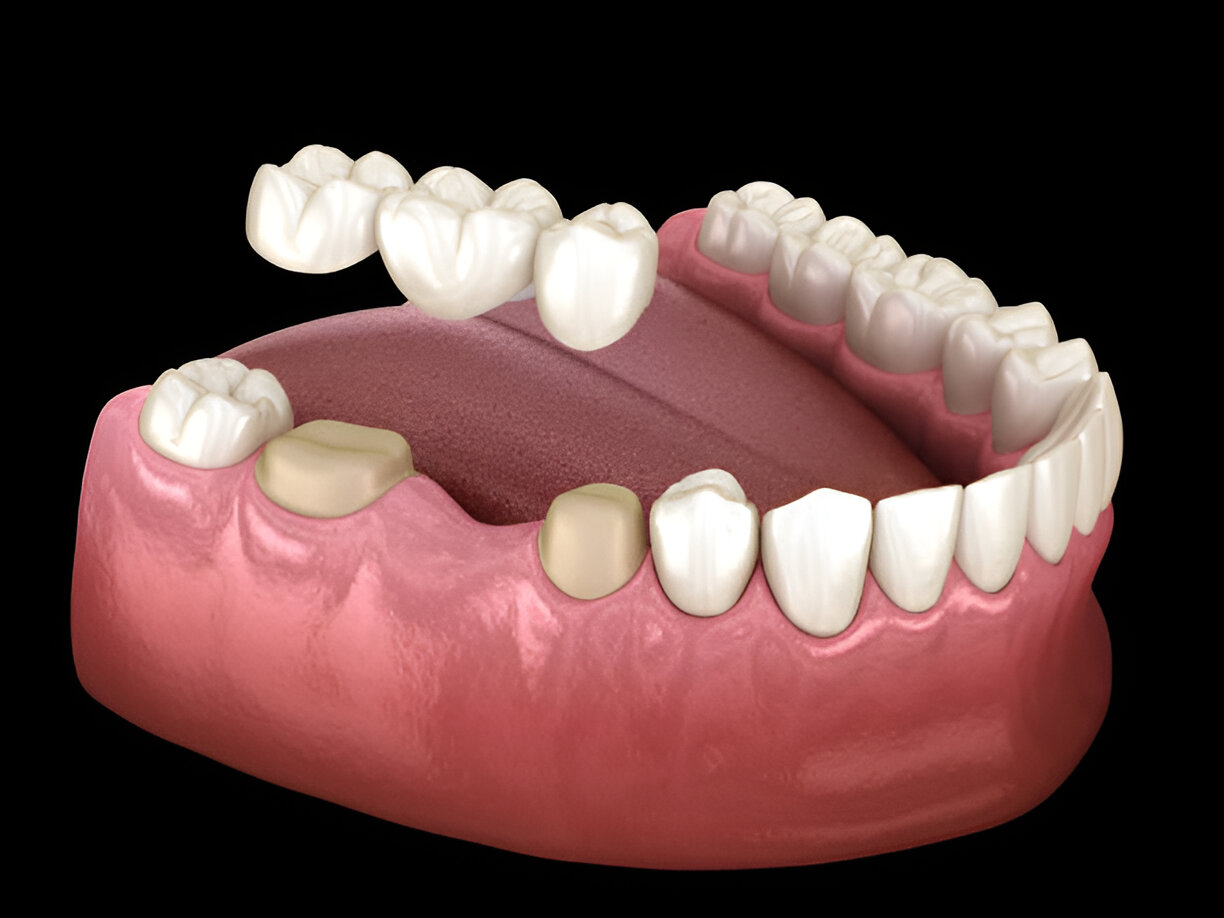 How Long Do Dental Crowns Last? Understanding Longevity and Care_1