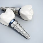 Carolina Smiles Family Dentistry: Leading Dentists in West Columbia, SC, for Quality Dental Implants_FI