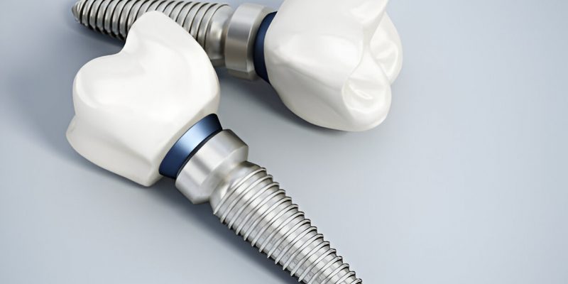 Carolina Smiles Family Dentistry: Leading Dentists in West Columbia, SC, for Quality Dental Implants_FI